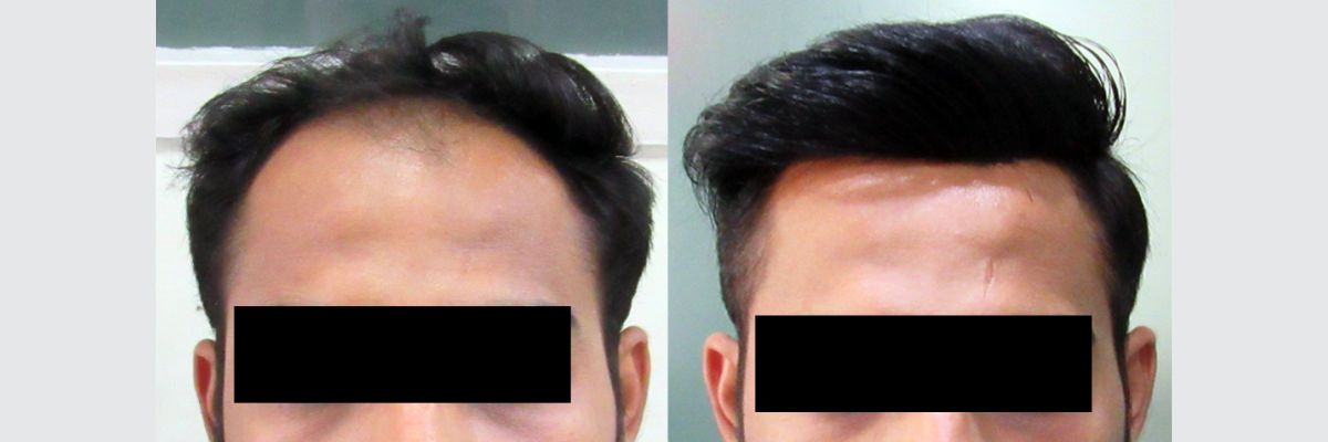 Hair Replacement Treatment in Delhi, India