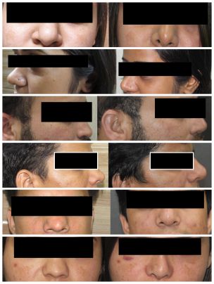 Rhinoplasty (Nose Surgery) - Before & After
