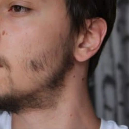 benefits of Hair Transplant