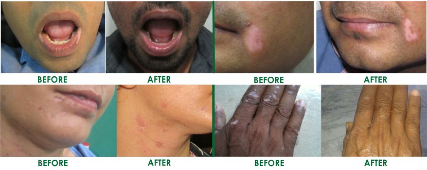 Vitiligo Treatment Delhi India, Vitiligo Treatment Clinic Delhi