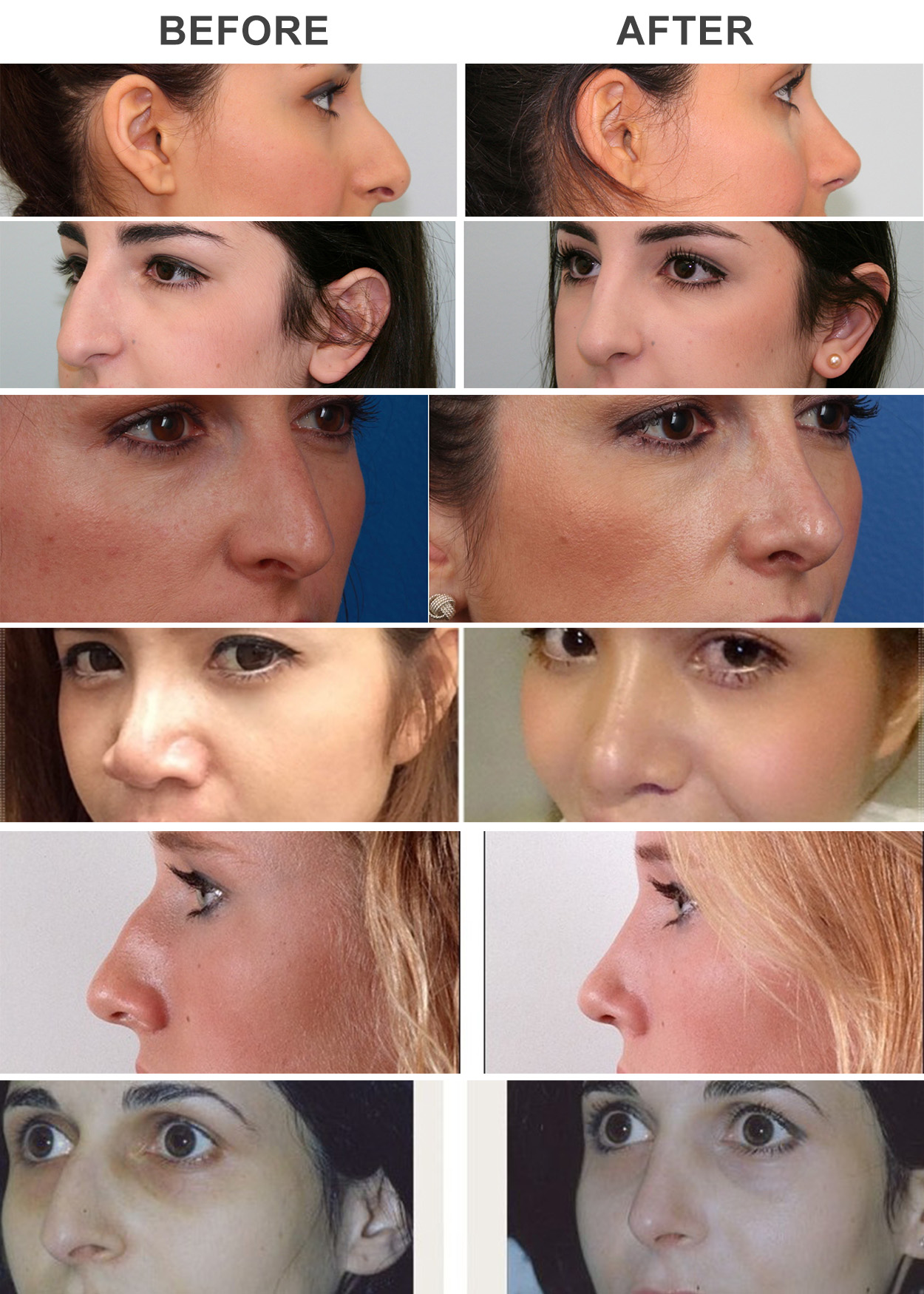 Best cost of Rhinoplasty in DelhiNose Surgery in Delhi by Best Cosmetic Surgeon