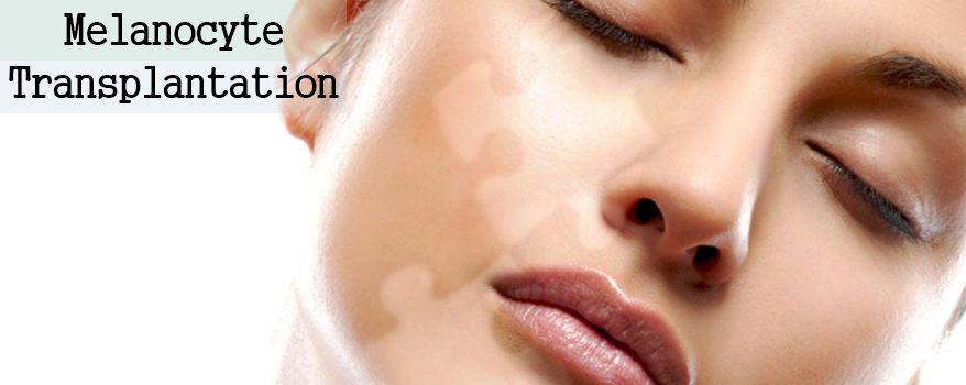 Melanocyte Transplantation Delhi, Skin care Doctor Delhi